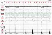 اختلال حرکات دوره ای اندام  Periodic Limb Movement Disorders - PLMD